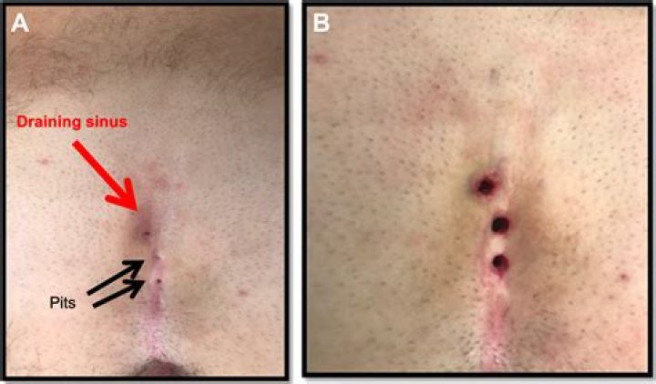 Does pilonidal cyst surgery leave a scar?