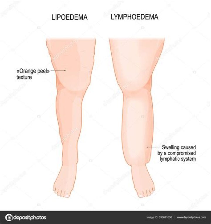 How can you tell the difference between edema and swelling?