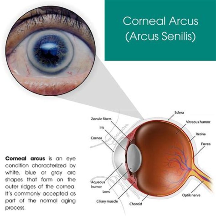 How do you get rid of Arcus Senilis naturally?