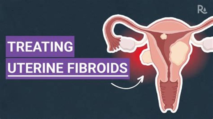 How do you treat degenerative fibroids?