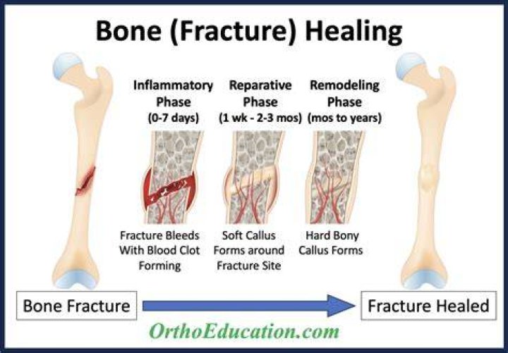 How long does it take for an occult fracture to heal?