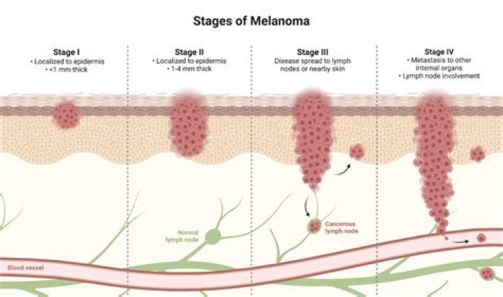 How serious is a Level 4 melanoma?