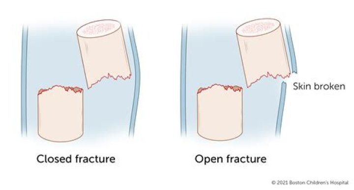 Is a closed fracture a clean break?