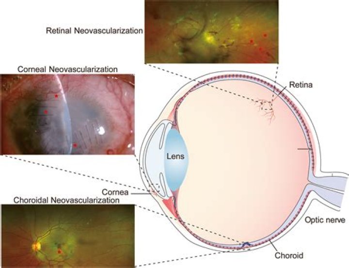 What causes neovascularization of the cornea?