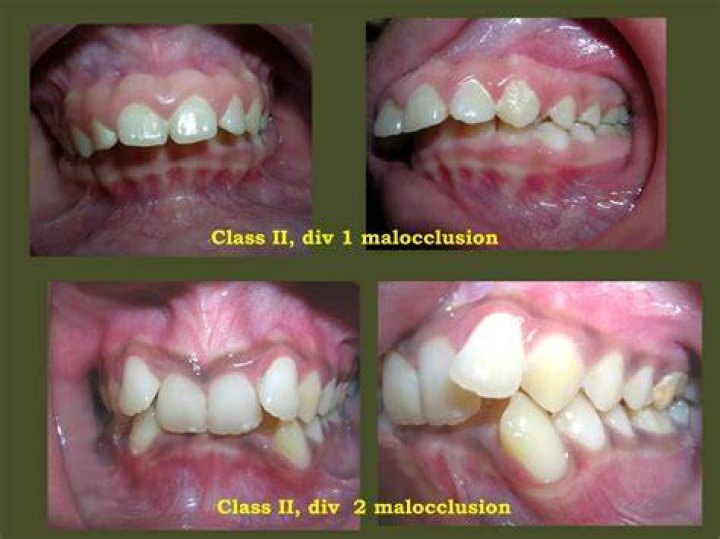 What is a Class II malocclusion?