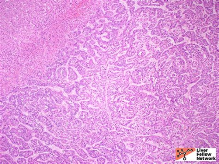 What is hepatocellular carcinoma PDF?