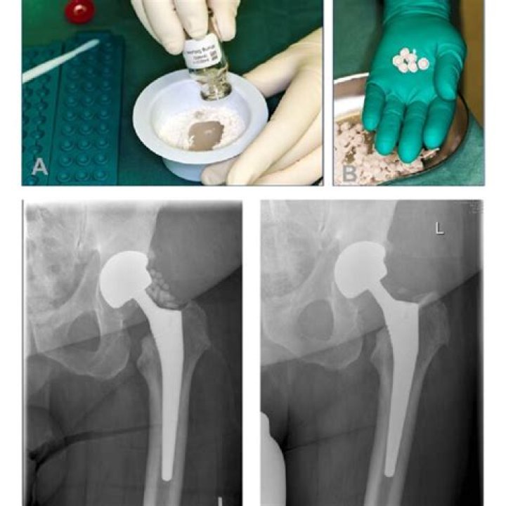 What is OSTEOSET made of?