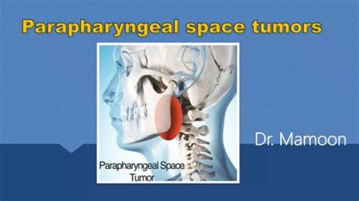 What is Parapharyngeal tumor?