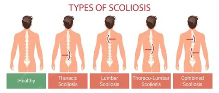 What is S shaped thoracolumbar scoliosis?