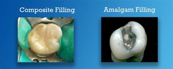 Which is better amalgam or composite filling?