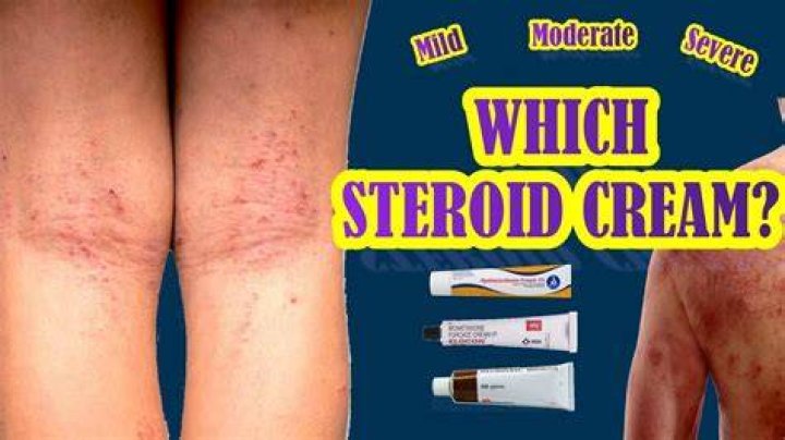 Which steroid cream is best for eczema?
