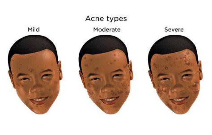 Why is my acne so bad at 27?